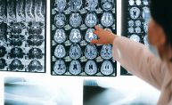 Los laboratorios ponen el foco en el Alzheimer